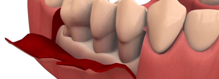 ¿Qué es la periodoncia y cuáles son los tratamientos? periodoncia-que-es-tratamientos